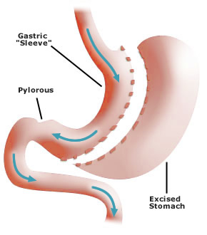 SLEEVE GASTRECTOMY